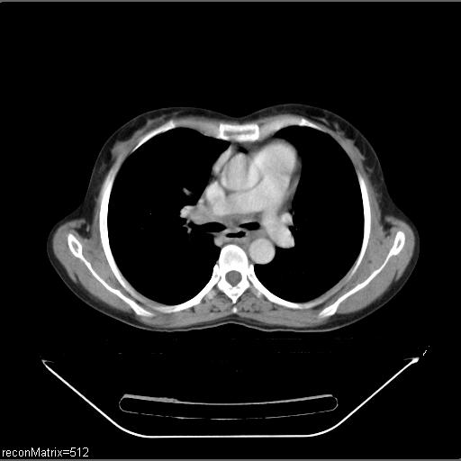 File:Carcinoma of esophagus (Radiopaedia 27356-27550 A 20).jpg