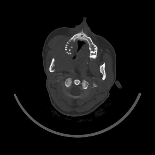 Carcinoma of the maxillary antrum (Radiopaedia 53805-59888 Axial bone window 71).jpg