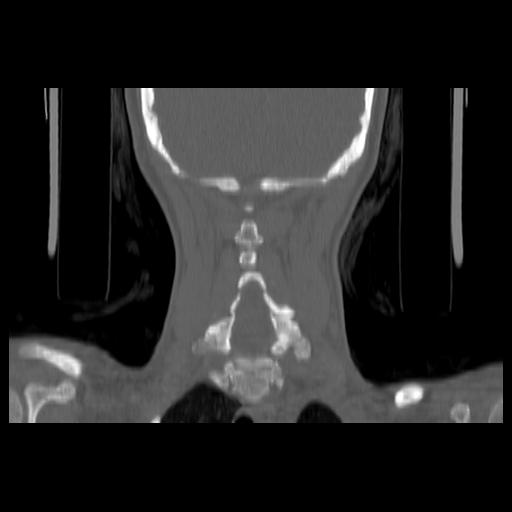 Carcinoma of the maxillary antrum (Radiopaedia 53805-59888 Coronal bone window 121).jpg