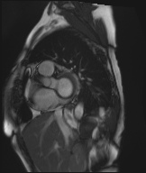 Cardiac amyloidosis (Radiopaedia 51404-57150 Sagittal CINE SSFP 274).jpg