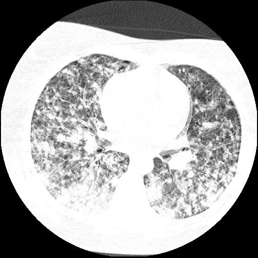 Cardiac angiosarcoma (Radiopaedia 66010-75181 Axial lung window 46).jpg