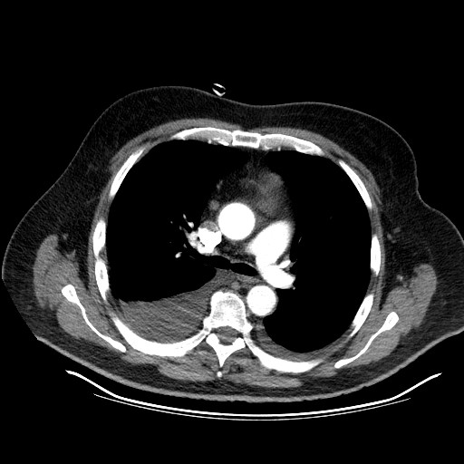 File:Cardiac lymphoma (Radiopaedia 38690-40836 Axial C+ CTPA 6).jpg