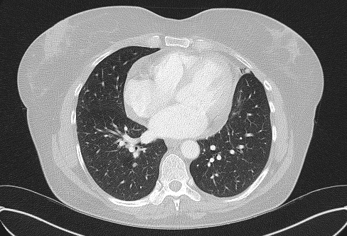 File:Cardiac sarcoidosis (Radiopaedia 74548-85534 Axial lung window 56).jpg