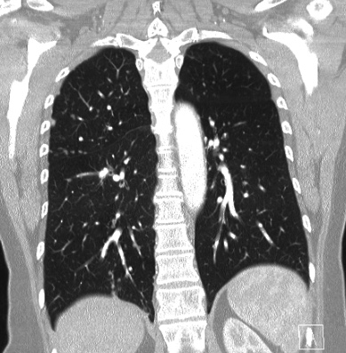 Cardiac sarcoidosis (Radiopaedia 74548-85534 Coronal lung window 48).jpg