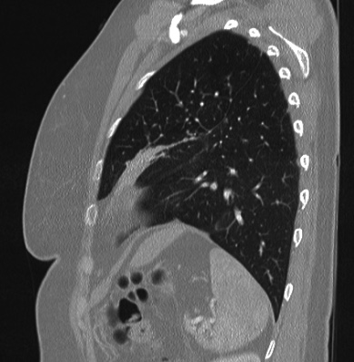 Cardiac sarcoidosis (Radiopaedia 74548-85534 Sagittal lung window 20).jpg