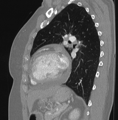 Cardiac sarcoidosis (Radiopaedia 74548-85534 Sagittal lung window 33).jpg