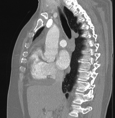 File:Cardiac sarcoidosis (Radiopaedia 74548-85534 Sagittal lung window 50).jpg