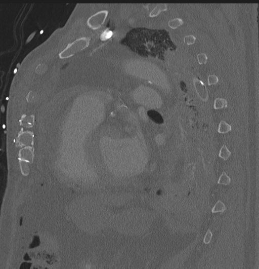 Cardiac trauma (Radiopaedia 32874-33858 Sagittal bone window 14).jpg
