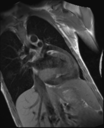 File:Cardiac tumor - undifferentiated pleomorphic sarcoma (Radiopaedia 45844-50136 Oblique T1 2).png