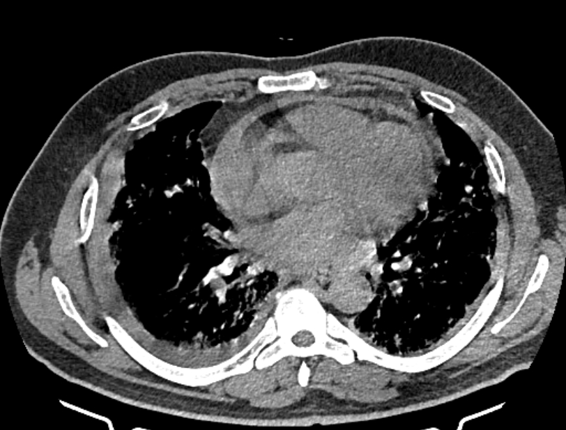 Cardiogenic pulmonary edema (Radiopaedia 68180-77678 Axial non-contrast 29).jpg