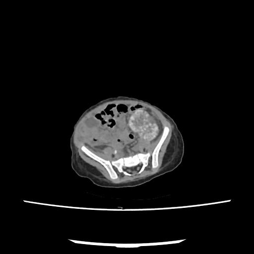 File:Caroli disease with autosomal recessive polycystic kidney disease (ARPKD) (Radiopaedia 89651-106703 E 184).jpg