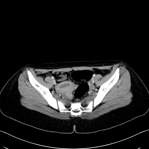 Caroli disease with medullary sponge kidney (Radiopaedia 82622-96804 C 63).jpg