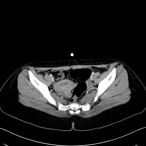 Caroli disease with medullary sponge kidney (Radiopaedia 82622-96804 C 64).jpg