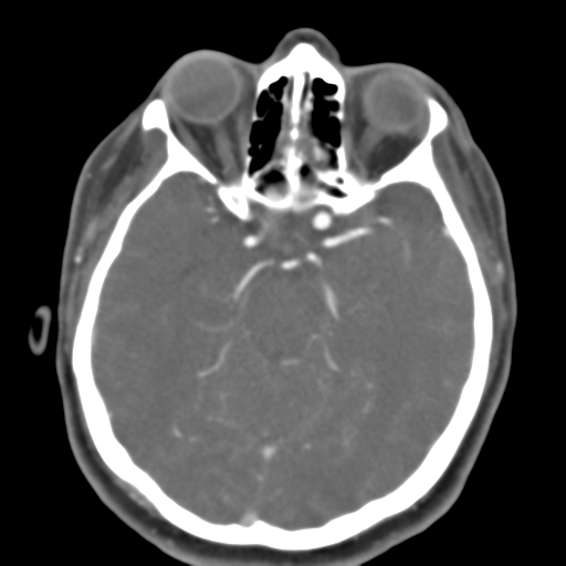 Carotico ophthalmic aneurysm (Radiopaedia 42916-46148 A 34).png