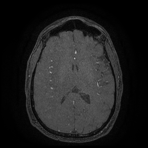 Carotid arterial dissection with acute cerebral infarction (Radiopaedia 26636-26784 MRA 66).jpg