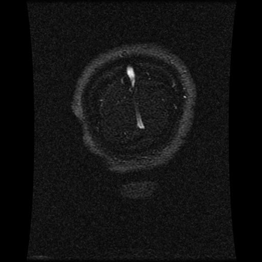 Carotid arterial dissection with acute cerebral infarction (Radiopaedia 26636-26784 MRV 35).jpg