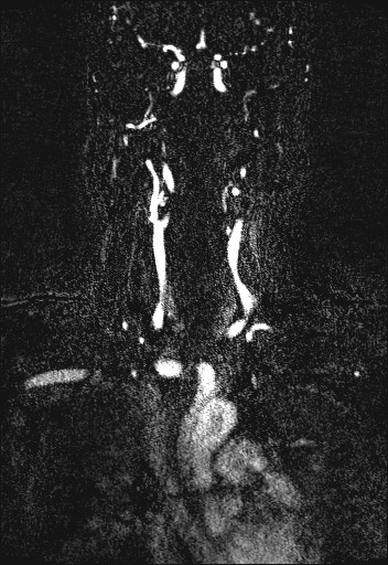 File:Carotid artery dissection (Radiopaedia 28441-28689 Coronal MRA 32).jpg