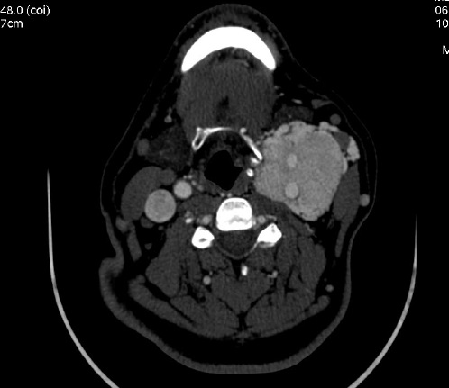 File:Carotid body tumor (Radiopaedia 17892-17654 C 1).jpg