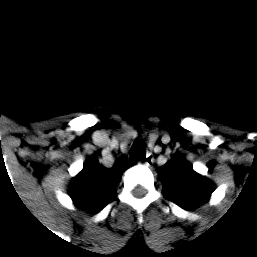 File:Carotid body tumor (Radiopaedia 27890-28124 A 29).jpg