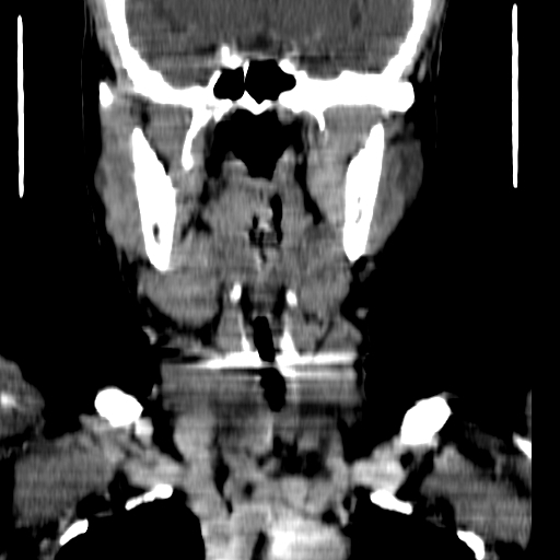 File:Carotid body tumor (Radiopaedia 27890-28124 B 13).jpg