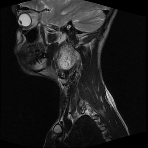 File:Carotid body tumor (Radiopaedia 30208-30823 Sagittal T2 15).jpg
