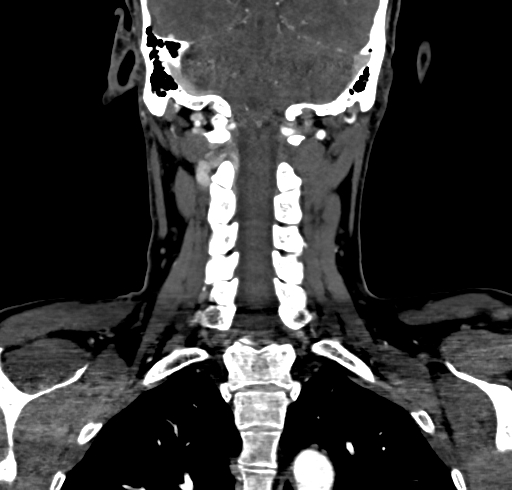 File:Carotid body tumor (Radiopaedia 83615-98727 B 93).jpg
