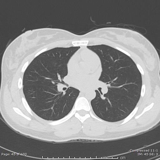 Catamenial pneumothorax (Radiopaedia 54382-60600 Axial non-contrast 45).jpg