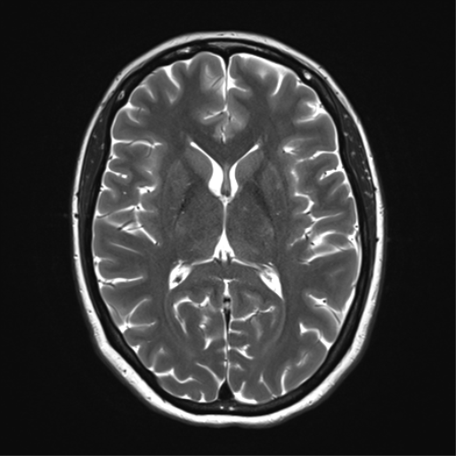 File:Cavernoma with bleed - midbrain (Radiopaedia 54546-60773 Axial T2 21).png