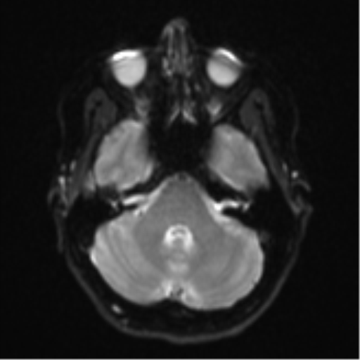 File:Cavernoma with bleed - midbrain (Radiopaedia 54546-60774 Axial DWI 6).png