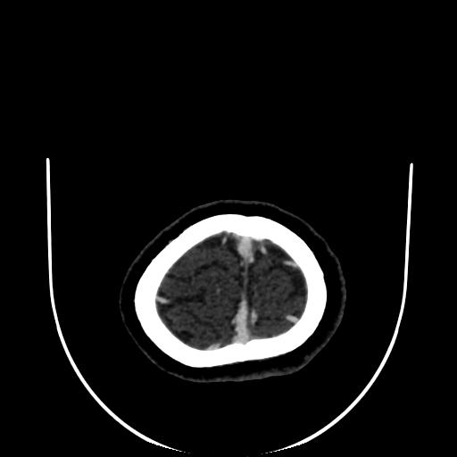Cavernoma with developmental venous anomaly (Radiopaedia 22470-22506 C 190).jpg
