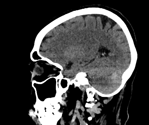 Cavernous hemangioma of the cerebellar falx (Radiopaedia 73025-83723 B 218).jpg