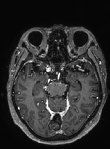 Cavernous hemangioma of the cerebellar falx (Radiopaedia 73025-83724 Axial T1 C+ 207).jpg
