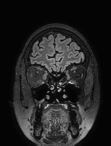 Cavernous hemangioma of the cerebellar falx (Radiopaedia 73025-83724 Coronal FLAIR 53).jpg