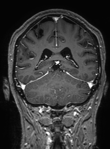 Cavernous hemangioma of the cerebellar falx (Radiopaedia 73025-83724 Coronal T1 C+ 255).jpg