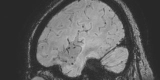 Cavernous hemangioma of the cerebellar falx (Radiopaedia 73025-83724 Sagittal BOLD 168).jpg