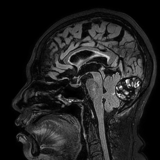Cavernous hemangioma of the cerebellar falx (Radiopaedia 73025-83724 Sagittal FLAIR 108).jpg