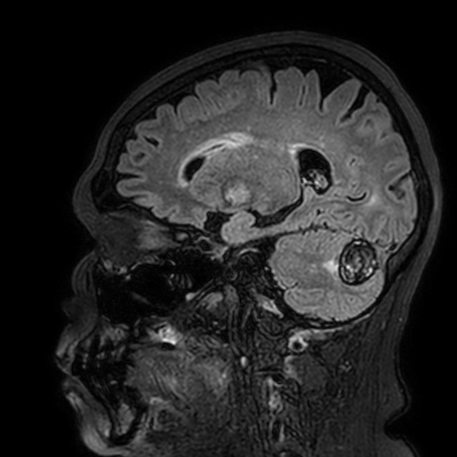 File:Cavernous hemangioma of the cerebellar falx (Radiopaedia 73025-83724 Sagittal FLAIR 75).jpg