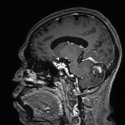 Cavernous hemangioma of the cerebellar falx (Radiopaedia 73025-83724 Sagittal T1 C+ 89).jpg