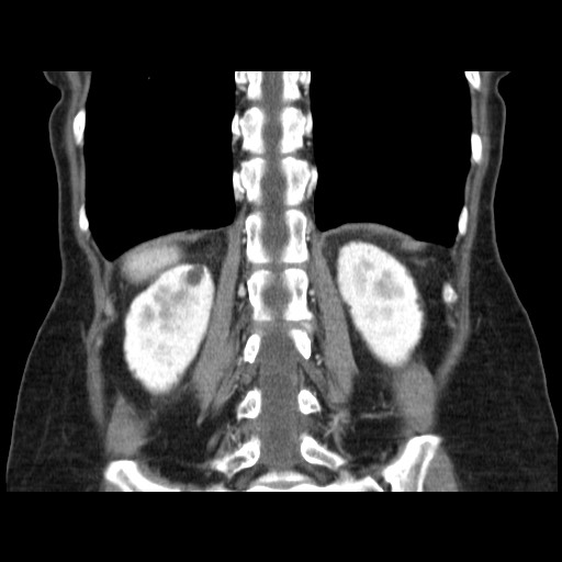 Cavernous hepatic hemangioma (Radiopaedia 75441-86667 C 110).jpg