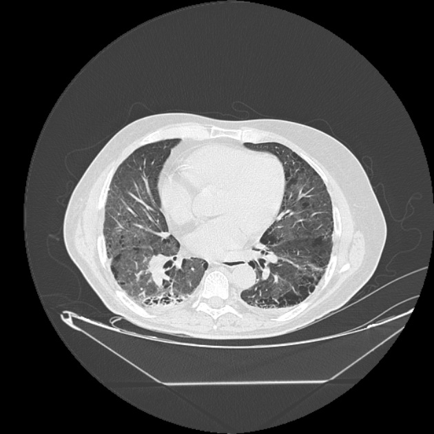 Cavitating bronchogenic carcinoma (Radiopaedia 44489-48162 Axial lung window 52).jpg