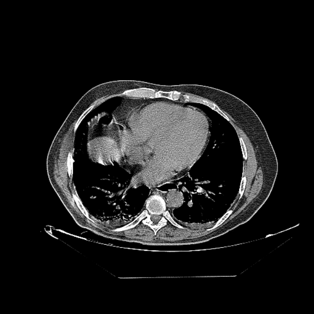 Cavitating bronchogenic carcinoma (Radiopaedia 44489-48162 Axial non-contrast 57).jpg