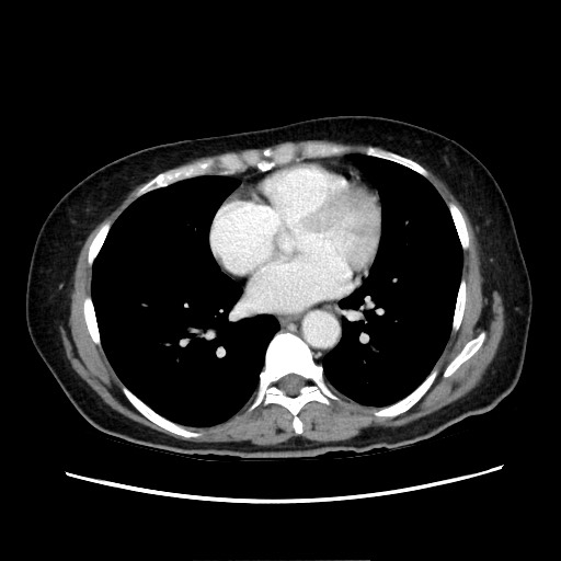 Cecal adenocarcinoma (Radiopaedia 75909-87331 A 7).jpg
