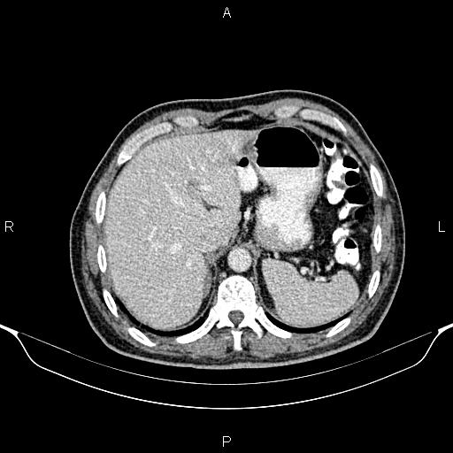 Cecal adenocarcinoma (Radiopaedia 85324-100916 B 17).jpg