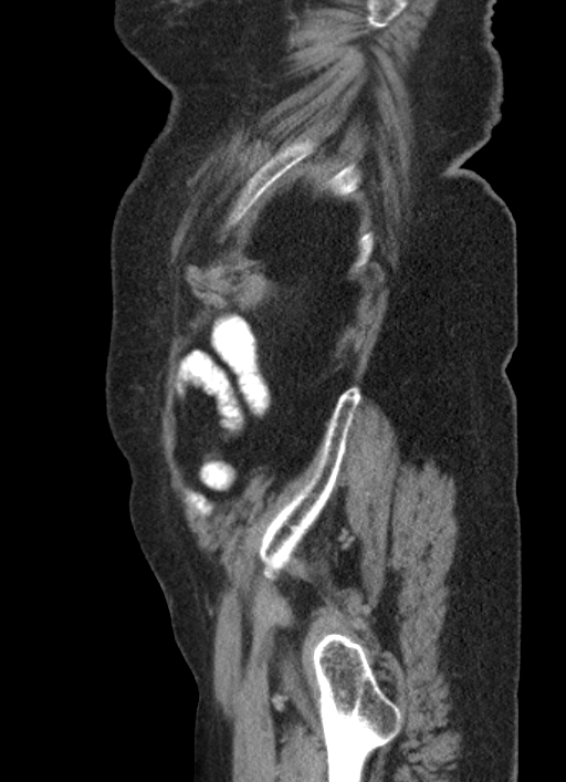 Cecal adenocarcinoma - surgical scar recurrence (Radiopaedia 79988-93264 D 57).jpg