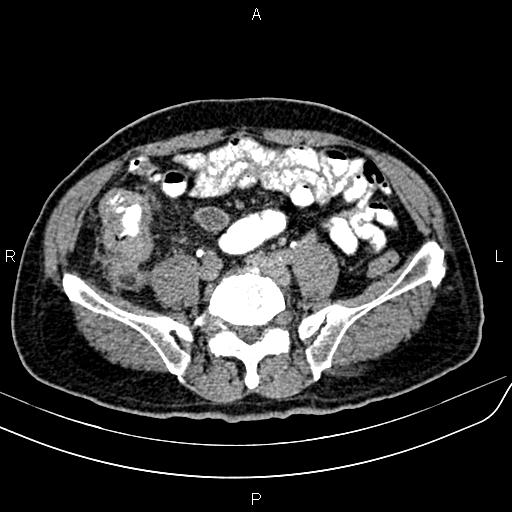File:Cecal cancer with appendiceal mucocele (Radiopaedia 91080-108651 Axial C+ delayed 52).jpg