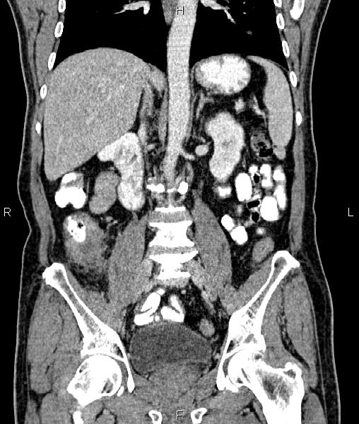 Cecal cancer with appendiceal mucocele (Radiopaedia 91080-108651 D 43).jpg