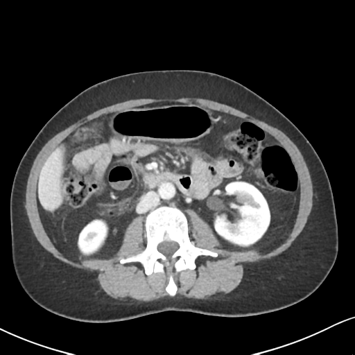 Cecal internal hernia through the foramen of Winslow (Radiopaedia 44820-48651 B 36).png