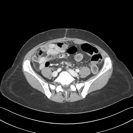 Cecum hernia through the foramen of Winslow (Radiopaedia 46634-51112 A 48).png