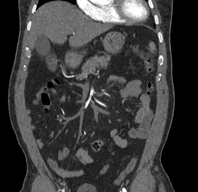 Celiac artery dissection (Radiopaedia 52194-58080 C 10).jpg