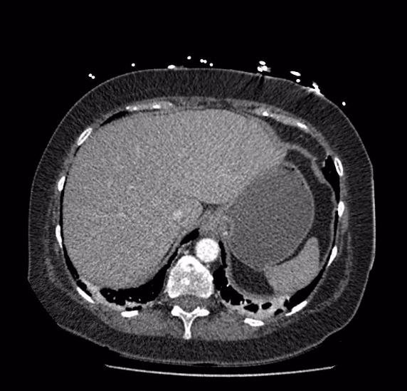 Celiac artery severe stenosis and dissection (Radiopaedia 44128-47842 B 9).jpg